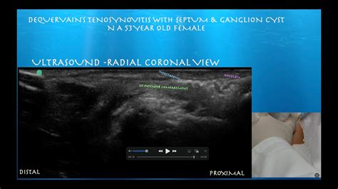 Ultrasound Guided De Quervain S Tenosynovitis Injection Youtube