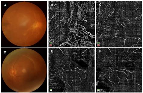 Jpm Free Full Text Effect Of Intravitreal Conbercept Injection On