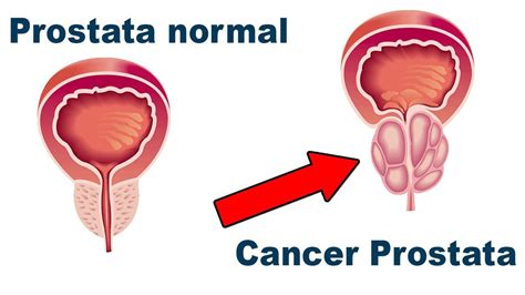 Qué es y qué debes conocer del cáncer de próstata Trujillo Perú