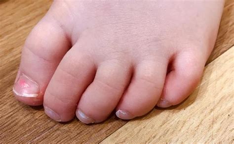 Curly Pinky Toe Otosection