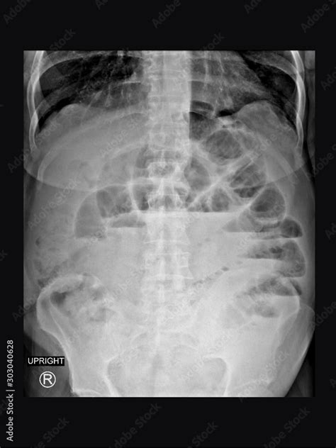 Film X Ray Upright Abdomen Radiograph Show Small Bowel Dilatation And
