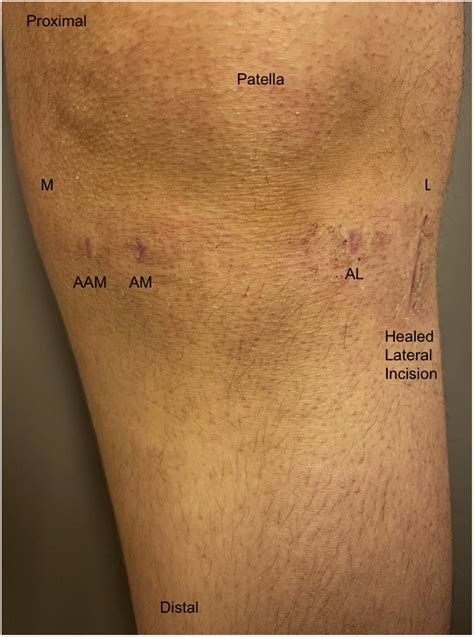 Postoperative Image Of The Knee Demonstrated Healed Surgical Incisions