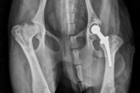 Total Hip Replacement Fitzpatrick Referrals