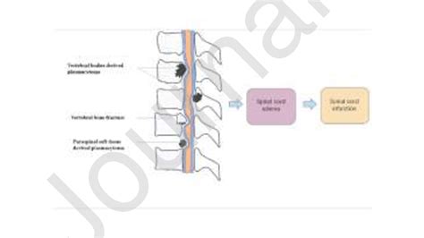Spinal Cord Compression In Multiple Myeloma Spinal Cord Compression