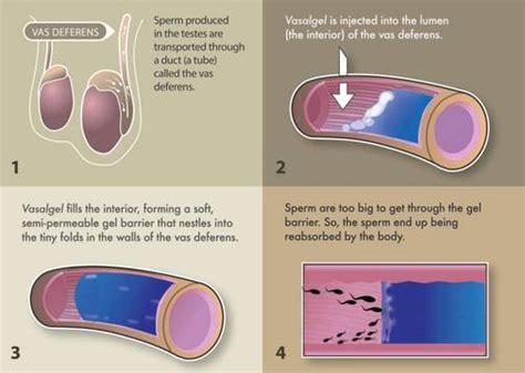 no more vasectomies or even condoms scientists have devised a male contraceptive gel thats 100