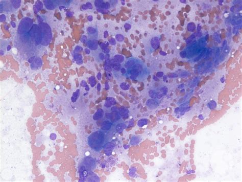 Neuroblastoma Cells In Marrow 4