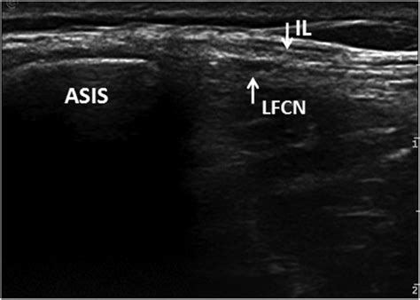 Ultrasound Of The Lateral Femoral Cutaneous Nerve In Asymptomatic