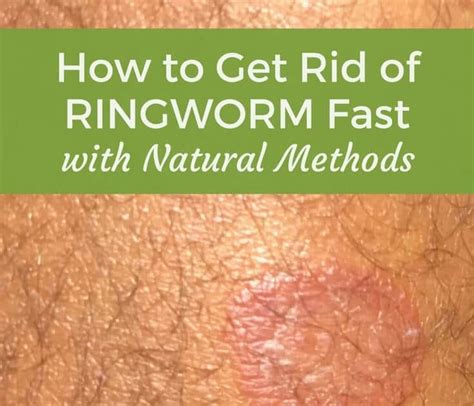 How To Get Rid Of Ringworm In Humans Pena Factere