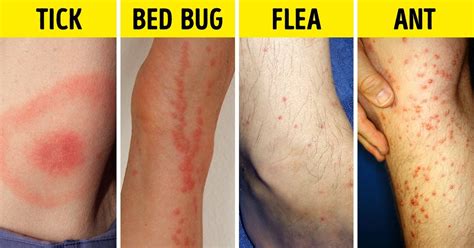 Images Of Bed Bug Bites On Humans See Spider Bite Pictures And Learn How To Identify Bug Bites