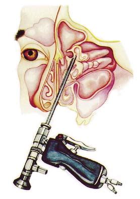 Learn all about ovarian polyps, treatment, procedure, cost, recovery and question & answer. Sinus Surgery India Cost - Endoscopic Sinus Surgery Mumbai ...