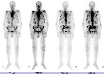 Prostate Cancer Bone Scan Mets Hot Sex Picture
