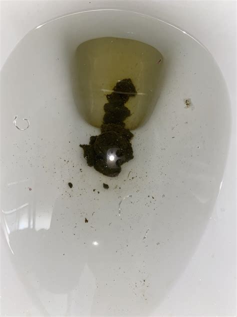 Very Dark Green Poopdiarrhea Stomach Gurgling Should I Be Worried