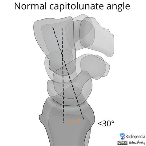 Filenormal Wrist Alignment Dorsal And Volar Intercalated Segmental