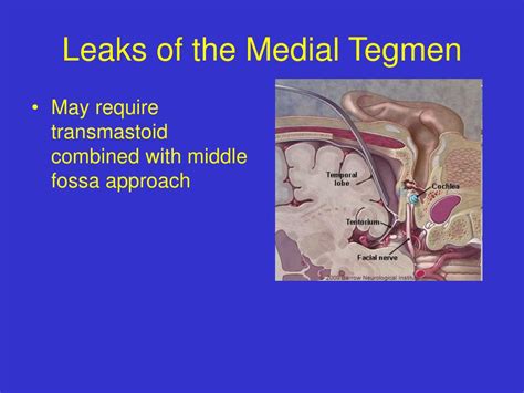 Ppt Temporal Bone Fractures And Surgical Approaches For Csf Leaks