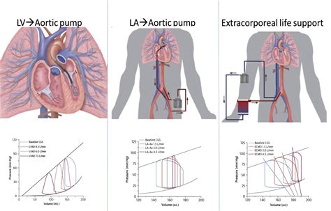 Hemodynamics Of Cardiogenic Shock Interventional Cardiology Clinics