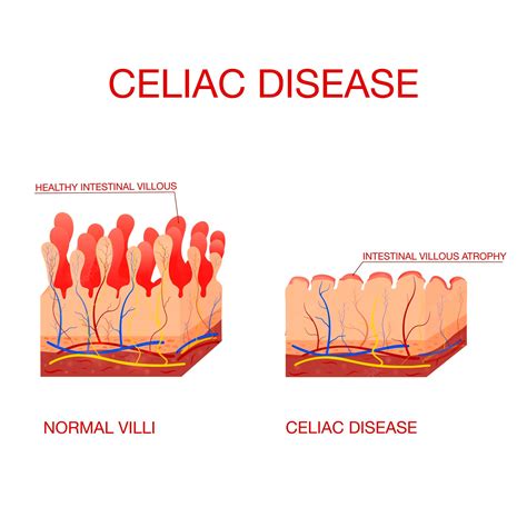 Premium Vector Coeliac Disease Or Celiac Diseasehealthy And Damaged Villi