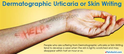 Dermatographic Urticaria Or Skin Writing