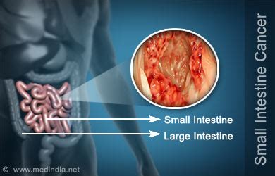 Signs that a person may have intestinal cancer are lumps in the abdomen, bloody stools, jaundice, unexplained weight loss, nausea, lack of appetite, and pain in the abdomen after meals. Small Intestinal Cancer Risk Factors Symptoms Diagnosis ...