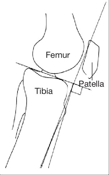 Measurement Of The Posterior Tibial Slope Download Scientific Diagram