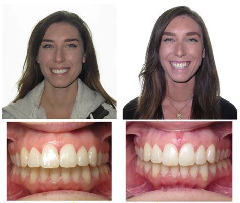 Can Invisalign Actually Fix An Overbite Impact Orthodontics