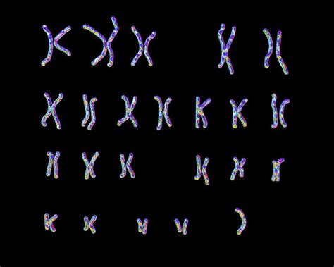Turner S Syndrome Karyotype Photograph By Kateryna Kon Science Photo Library Fine Art America