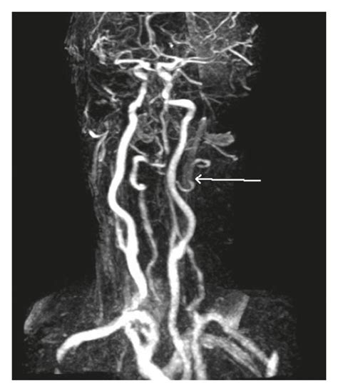 Cta Showing Left Vertebral Artery Dissection Download Scientific Diagram