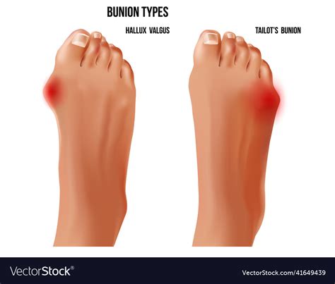 Artritic Tailors Bunion And Hallux Valgus Foot Vector Image