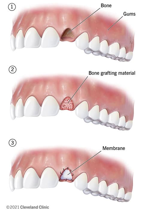 Normal Healing After Tooth Extraction