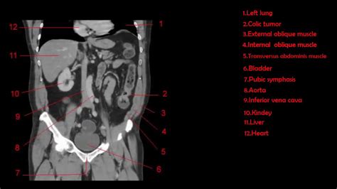 Abdominal Anatomy Ct Abdomen And Pelvis Anatomy Of The Dog On Ct