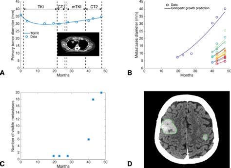 Lung Cancer Metastasis To Brain Life Expectancy Without ...