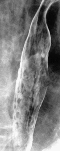 Infectious Esophagitis Radiology Key