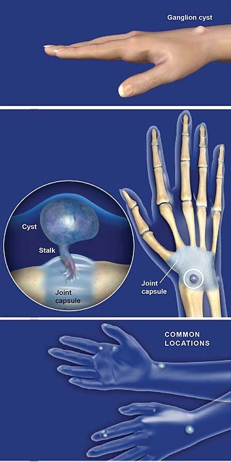Ganglion Cyst Removal Specialist Clinic Singapore Sports And Orthopaedic Clinic Neurosurgeon