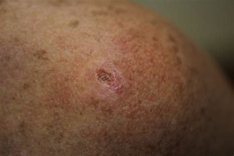Skin Cancer Survival Ratesrzphp