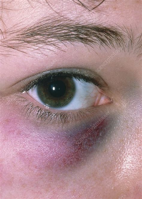 Black Eye Periorbital Bruising Stock Image M3300517 Science