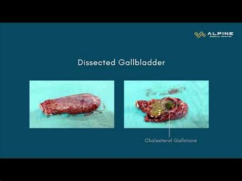 Laparoscopic Cholecystectomy Keyhole Gallbladder Removal Surgery