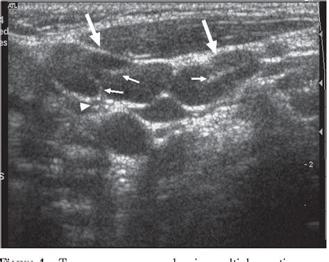 Figure 4 From Ultrasonography Of Neck Lymph Nodes In Children