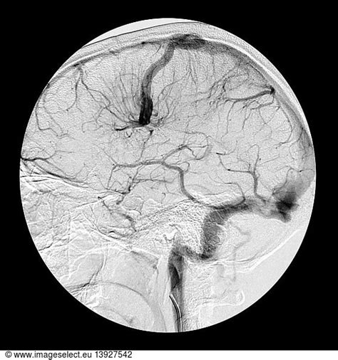 Large Developmental Venous Anomaly With Av Shunting And Bleed Large