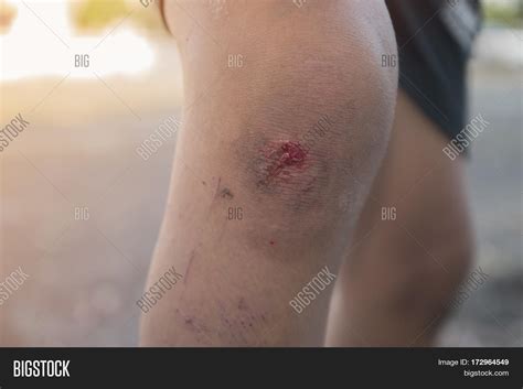 Infected Wound On Leg Image And Photo Free Trial Bigstock