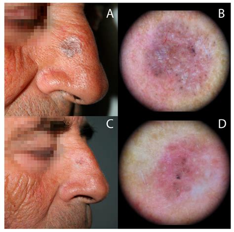 Biomedicines | Free Full-Text | Photodynamic Therapy ...