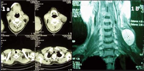 a) Computed tomography neck and thorax showed a well defined cystic ...