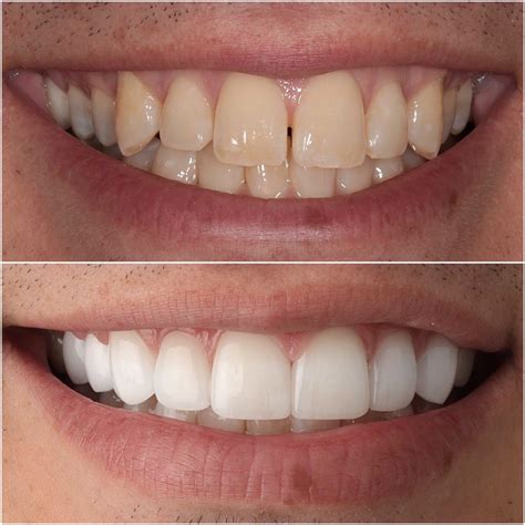 Porcelain Veneers in Beverly Hills | Best Veneers Dentist Near You