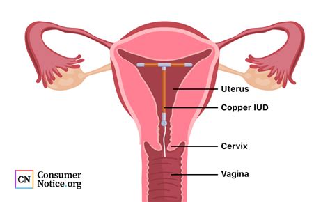 Paragard Iud Insertion And Removal Side Effects Litigation