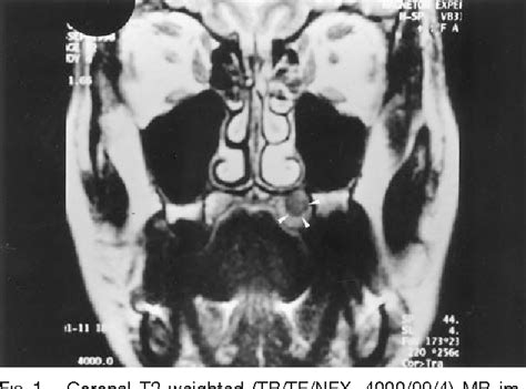 Figure 1 From Granular Cell Tumor Of The Palate A Case Report