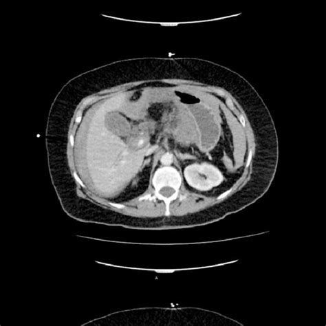 A A Contrast Enhanced Ct Of The Abdomen Shows A Large Fluid