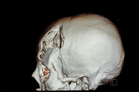 Skull Fracture Facts Symptoms Complications And Treatment Factdr