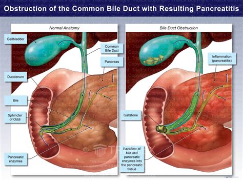 Obstruction Of The Common Bile Duct With Resulting Pancreatitis