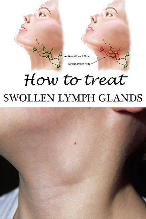 How To Treat Swollen Lymph Glands Lymph Glands Swollen Lymph Nodes