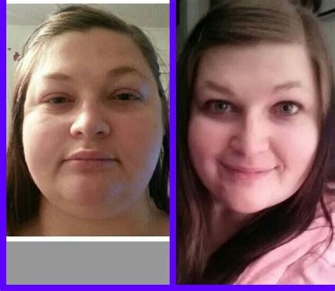 Facial Changes With Hypothyroidism