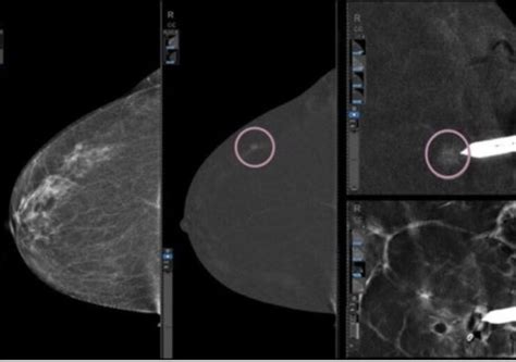 Ge Healthcare Introduces Serena Bright Contrast Enhanced Guided Biopsy