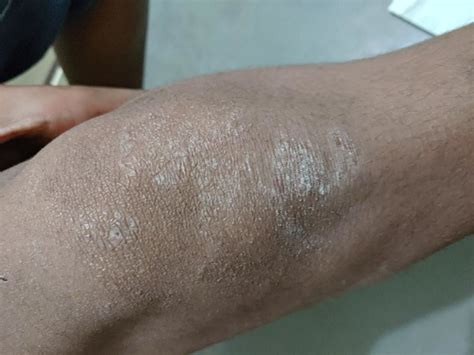 Types Of Dermatitis